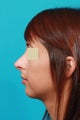 Open Septorhinoplasty