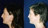Rhinoplasty and Septoplasty