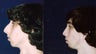 Rhinoplasty and Septoplasty