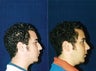 Rhinoplasty and Septoplasty