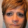 Reconstructive Septorhinoplasty