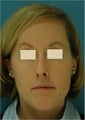 Rhinoplasty, Septoplasty