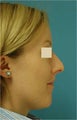 Rhinoplasty, Septoplasty