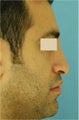 Rhinoplasty, Septoplasty