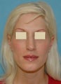 Rhinoplasty and Septoplasty