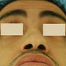 Rhinoplasty, Septoplasty