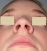 Rhinoplasty and Septoplasty