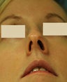 Rhinoplasty, Septoplasty