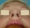 Rhinoplasty, Septoplasty