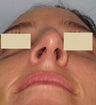 Rhinoplasty, Broken Nose