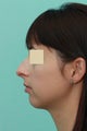 Open Septorhinoplasty