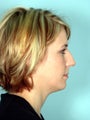 Rhinoplasty