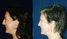 Rhinoplasty and Septoplasty