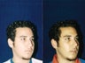 Rhinoplasty and Septoplasty