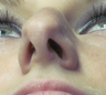 Septoplasty