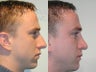 Septoplasty