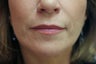 Lip Augmentation with Silicone