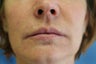 Silicone Microdroplets for Lip Augmentation