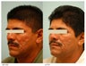 Acne Scarring Correction