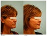 Acne Scarring Correction