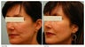 Acne Scarring Correction