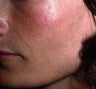 Facial Volumizing