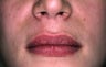 Lip Augmentation