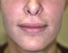 Lip Augmentation with Liquid Injectable Silicone