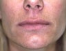 Lip Augmentation with Liquid Injectable Silicone