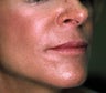 Correction of Facial Aging Grooves