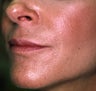 Correction of Facial Aging Grooves