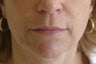 Lip Augmentation with Silicone