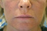 Silicone Microdroplets for Lip Augmentation