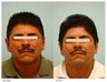 Acne Scarring Correction