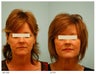 Acne Scarring Correction