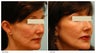 Acne Scarring Correction