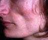 Facial Volumizing