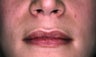 Lip Augmentation