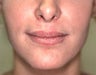 Lip Augmentation with Liquid Injectable Silicone