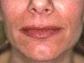 Lip Augmentation with Liquid Injectable Silicone
