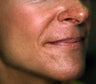 Correction of Facial Aging Grooves