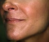 Correction of Facial Aging Grooves