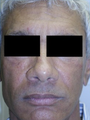 Silicone Microdroplet Therapy for Facial Atrophy