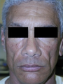 Silicone Microdroplet Therapy for Facial Atrophy