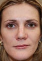 Silikon-1000 for lip augmentation and non-surgical nose job with IPL PhotoFacial