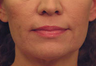 Laser Skin Tightening
