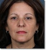 ZPL Peel Light Laser (Weekend Peel) Skin Rejuvenation