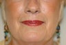 Before and Resurfacing Coblation Skin Resurfacing