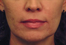 Laser Skin Tightening