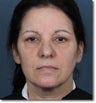 ZPL Peel Light Laser (Weekend Peel) Skin Rejuvenation